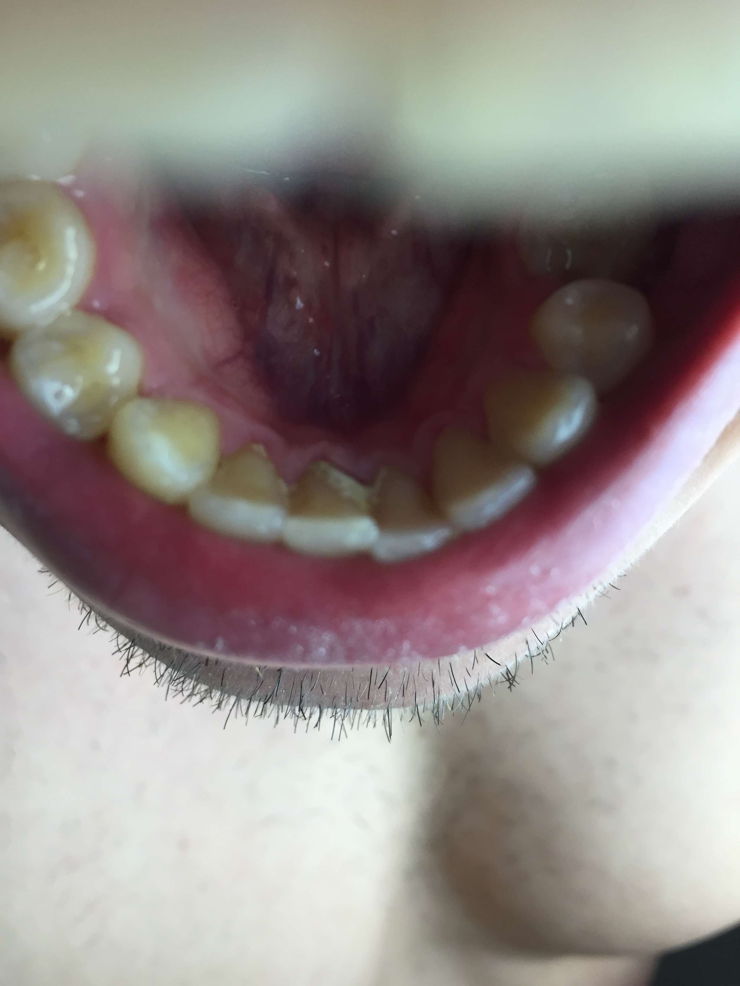 Abgebrochen vom kleines stück zahn Abgebrochener Zahn